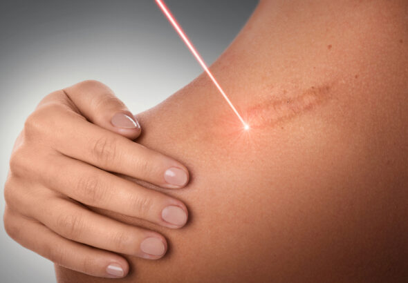 Female,Shoulder,And,Laser,Beam,During,Scar,Removal,Treatment