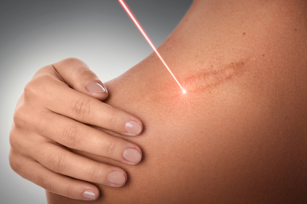 Female,Shoulder,And,Laser,Beam,During,Scar,Removal,Treatment